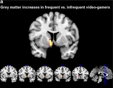 The relationship between frequent gaming and differences in brain structure is still unclear.