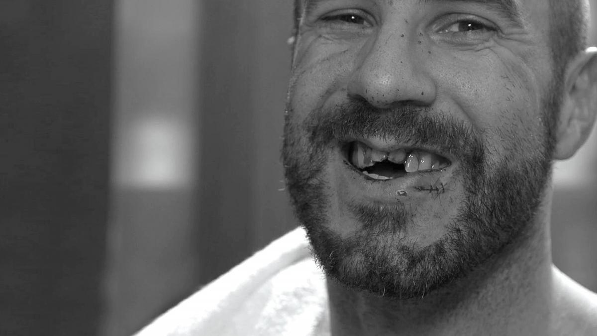 Cesaro's impacted teeth